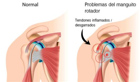 Artroscopia De Hombro Dr Jose Ignacio Gimeno Abad