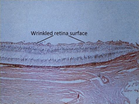 Moran Core Retina Rpe Histopathology