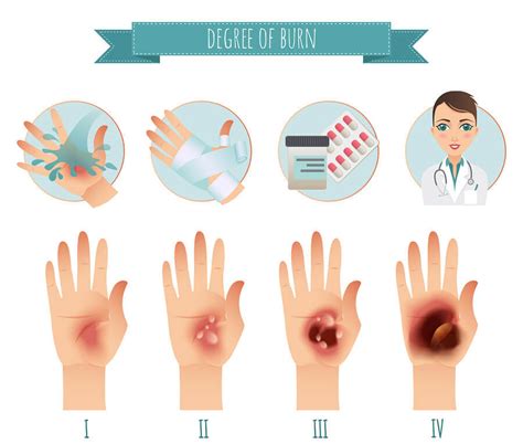 How To Naturally Treat A Burn At Home Effective Home Remedies For Soothing And Healing Burns