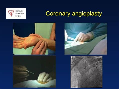 Angioplasty Ppt