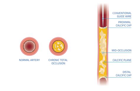 Chronic Total Occlusions CTO Challenges Vascular Clarification