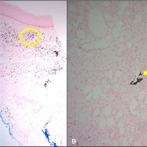 Early Calciphylaxis Lesions With Violaceous Discoloration On Hospital