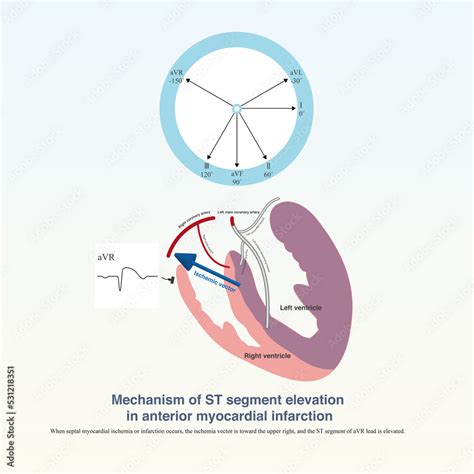 Acute Left Main Trunk Occlusion Acute Left Anterior Descending Artery