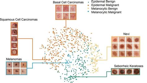 How Neural Networks Are Being Used For Skin Cancer Classification