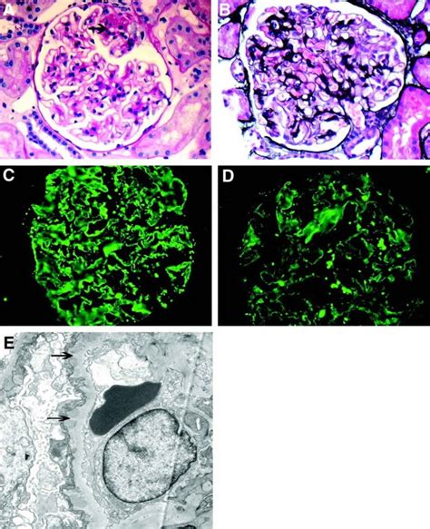 Membranous nephropathy, causes, symptoms, diagnosis, treatment & prognosis