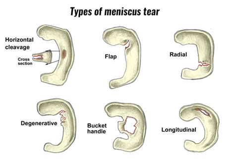 Can Meniscus Tears Heal Without Surgery