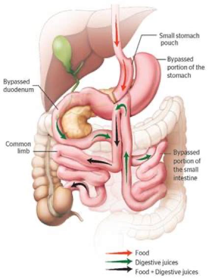 Roux En Y Gastric Bypass Weight Loss Surgery