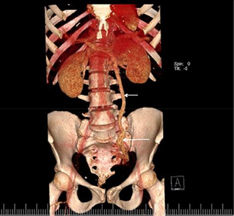 Volume Rendered Image From Renal Vein Cta Reveals Left Gonadal Vein