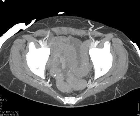 Ulcerative Colitis Colon Case Studies Ctisus Ct Scanning