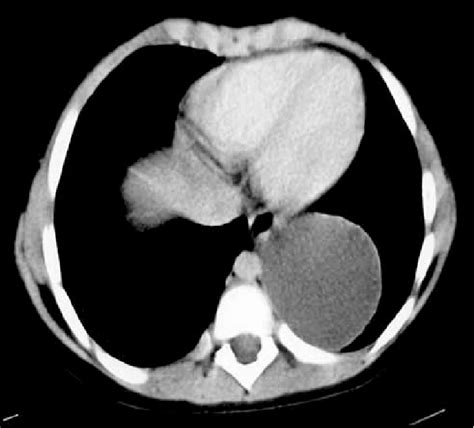 Cystic Lesion With Brownish Fluid In The Cyst Fig 1 Computed Download Scientific Diagram