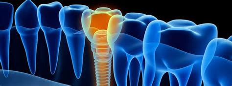 Herausnehmbarer Zahnersatz M Glichkeiten Kosten Dentolo