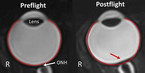 Mri Based Quantification Of Posterior Ocular Globe Flattening During 60