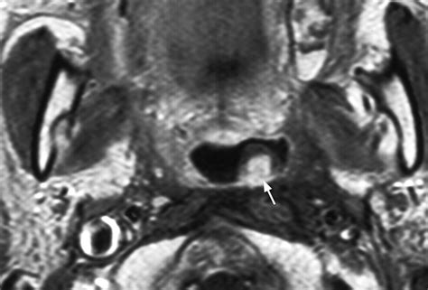 Nasal Polyp Mri