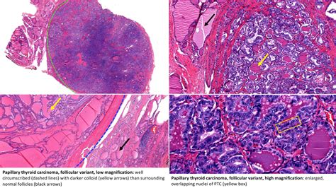 Variants Of Papillary Thyroid Carcinoma Microcarcinoma Tall Cell