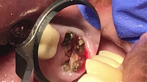 Broken Wisdom Tooth Extraction