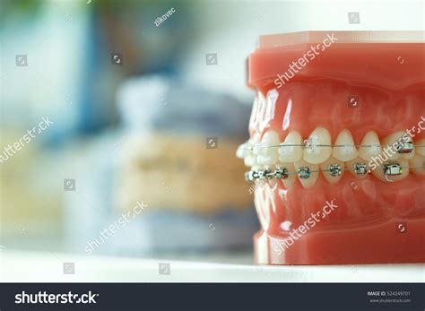 14 406 Imágenes De Aparato Ortodoncia Imágenes Fotos Y Vectores De