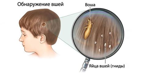 5 міфів про воші - літають вона, як швидко бігають, чи можуть їх гниди ...