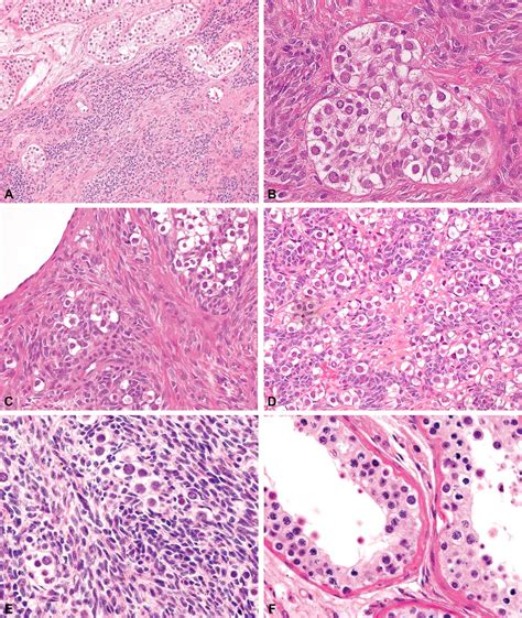 On The Histogenesis Of Mixed Germ Cell Sex Cord Stromal Tumour Of The