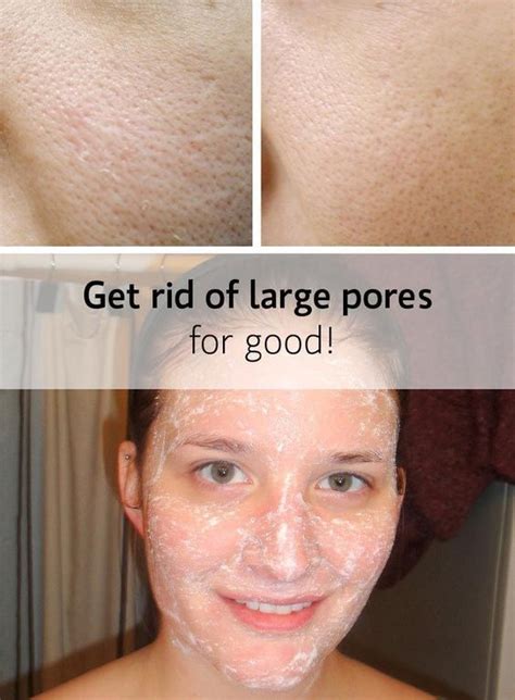 How To Get Rid Of Enlarged Pores Naturally Face Pores Best Pore Minimizer Skin Care Secrets