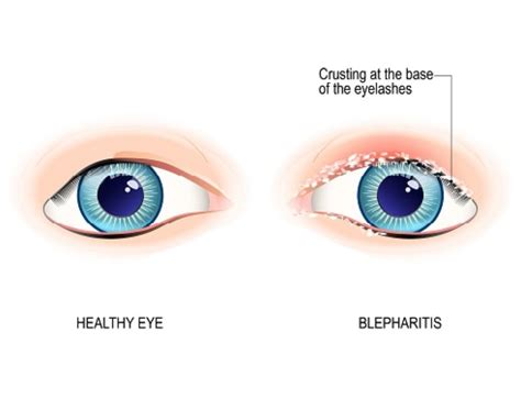 Blepharitis Symptoms And Treatment Fort Lauderdale Eye Institute