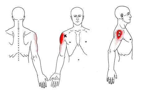 Deltoid Strain Symptoms