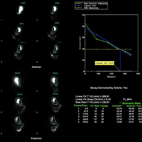 Scintigraphic Images Before The G POEM With Evidence Of Delayed