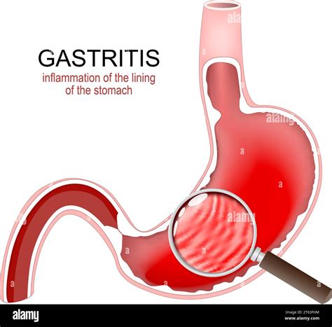 Gastritis Stomach Inflammation Gastrointestinal Disorders Cross