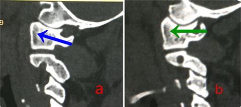 A C1 Pedicle Screw Trajectory Blue Arrow In A Normal Atlas B When A Download Scientific