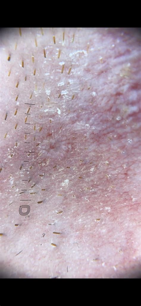 10X magnification - Demodex? : r/Rosacea