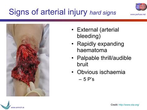 Vascular Trauma Ppt