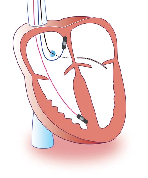 Basic Cardiac Pacing Pacemaker Functions And Settings Cardiovascular