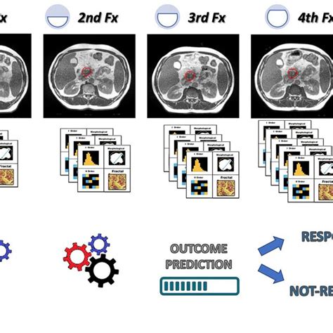 Example Of Clinical Implementation Of A Delta Radiomic Model During A