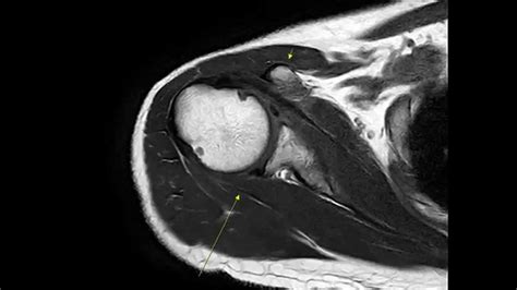 Portal Placement For Shoulder Arthroscopy 1 어깨관절내시경 포털 만들기1 달려라병원