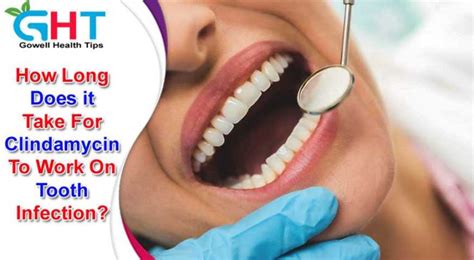 How Long Does it Take For Clindamycin To Work On Tooth Infection?