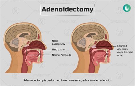 Adenoidectomy Before And After