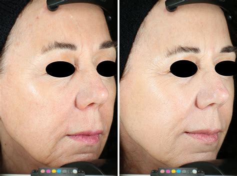 Before And After Vivace Rf Microneedling Aivi Aesthetics Skin Health