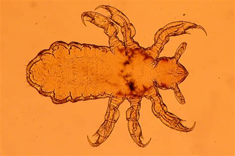 Pediculosis O Comunmente Piojos Causas Síntomas Y Tratamiento