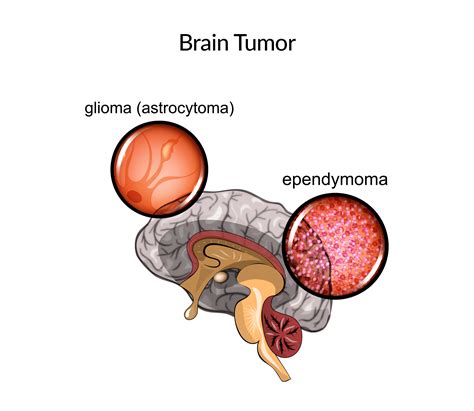 Brain Tumors Q A Nkrumah Neurosurgery