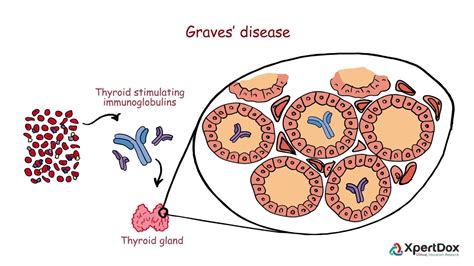 Graves Disease Diagram