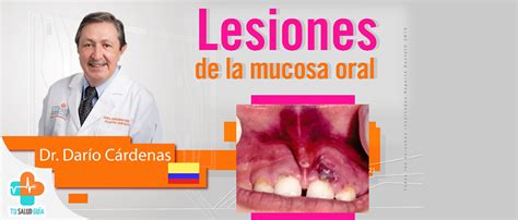 Lesiones De La Mucosa Oral Directorio M Dico Tu Salud Gu A