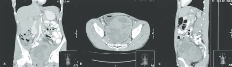 A Coronal Section Of Abdominal Ct Showed A X X Cm Retrovesically