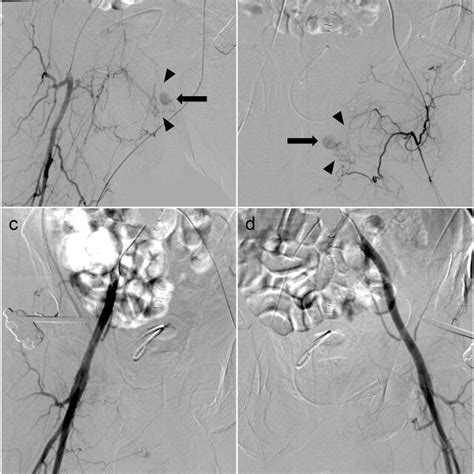 Pseudoaneurysms Shown By Angiography A Right Deep Femoral Artery Download Scientific Diagram