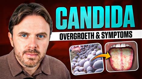 Overcoming Candida Overgrowth Causes Symptoms And Solutions Youtube