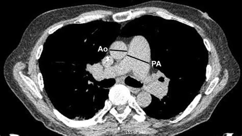 Hrct Of The Chest Mediastinal Windows Here We Take Measurements Of Download Scientific