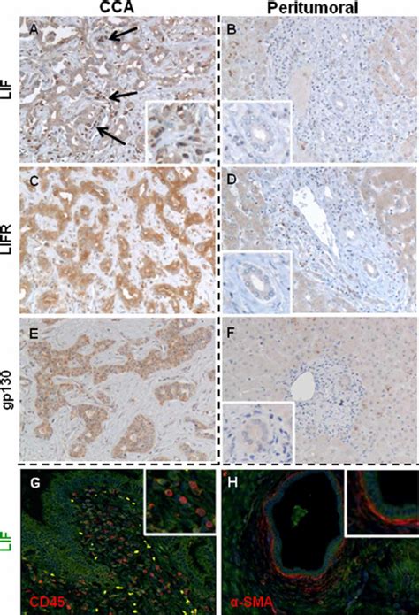 LIF LIFR And Gp130 Immunohistochemical Expression In CCA And