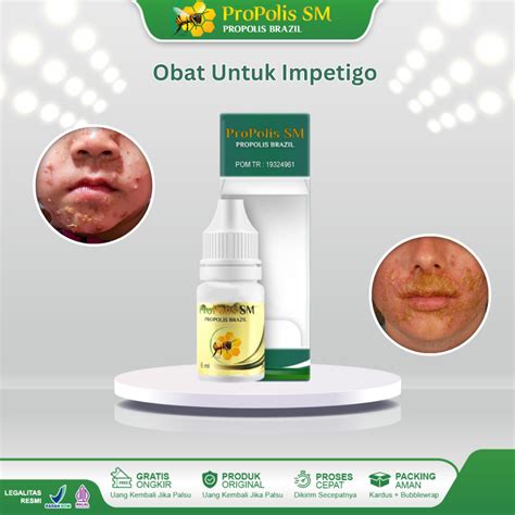 Jual Obat Impetigo Infeksi Bakteri Kulit Melepuh Dan Gatal Infeksi