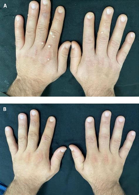 Figure From Intralesional Quadrivalent Human Papilloma Virus Vaccine