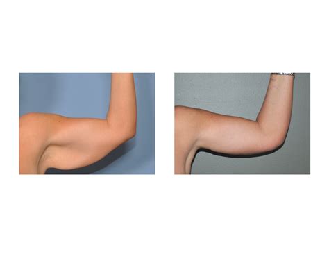 Case Study: Long-Term Scar Outcome From Arm Lifts - Explore Plastic Surgery
