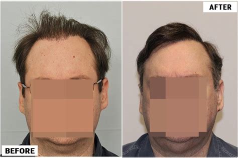 4800 Grafts Scalp Repair Results Forhair Before And After Photos