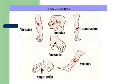 Heridas. Primeros auxilios